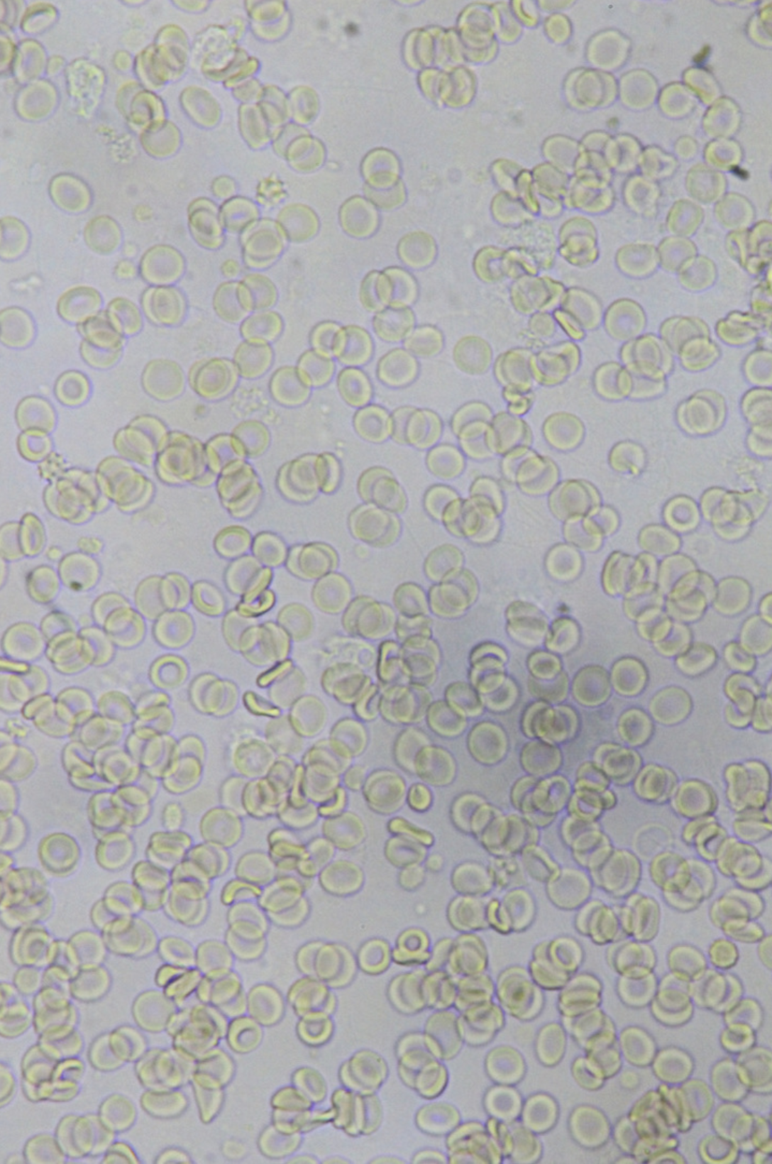 Blood Smear